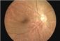 การตรวจสอบ Ophthalmoscope H.264 Digital Fundus Camera