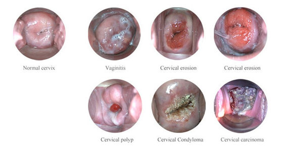 คอลปอสโกป์อิเล็กทรอนิกส์ดิจิตอลพกพา