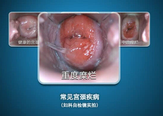 กล้อง Endoscope ตรวจสอบตนเองด้วยตนเอง Colposcope Mini Colposcopy พร้อมช่วงการสังเกต 70 ~ 100 มม