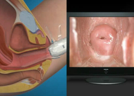 กล้อง Endoscope ตรวจสอบตนเองด้วยตนเอง Colposcope Mini Colposcopy พร้อมช่วงการสังเกต 70 ~ 100 มม