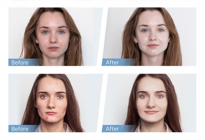 ขายจากโรงงาน Hydra Pen H5 EMS เครื่องฉีดไมโครเนดลิ่งไฟฟ้า สําหรับการฟื้นฟูคอลลาเจน การฟื้นฟูผม 4